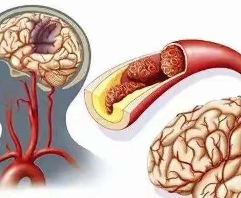 【周中医·脑病科】了解“小卒中”
