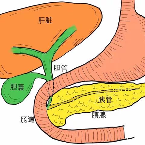 “石”事求是—胆囊结石的那些事儿