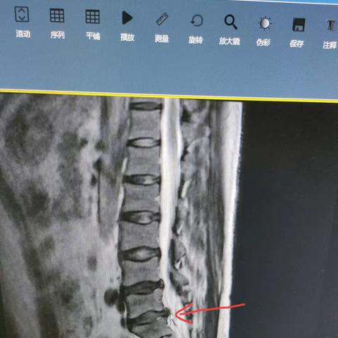 腰椎间盘突出症康复辩证治疗