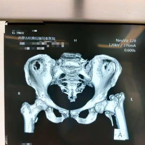 直面“人生最后一次骨折”———股骨粗隆间骨折