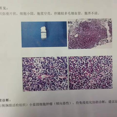 我院首例经CT引导下胸膜穿刺活检术开展啦！