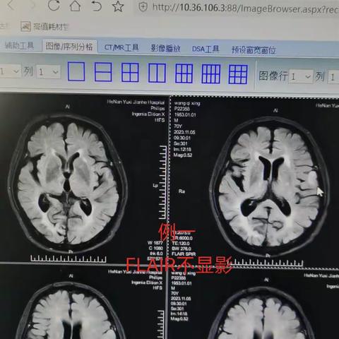 患了脑卒中不可怕！