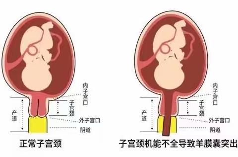 嘉峪关市妇幼保健院开展宫颈环扎术