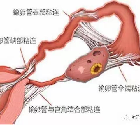 女性患者的福音—宫、腹腔镜手术技术