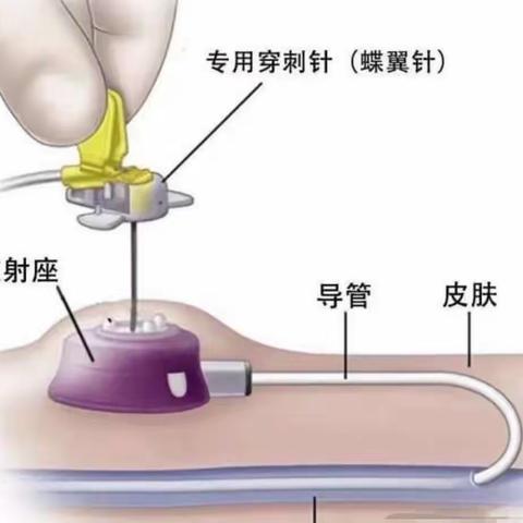 崇仁县人民医院开展输液港植入术