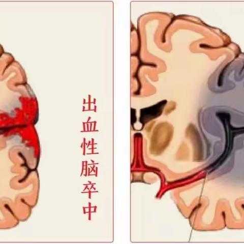 遇到脑卒中别慌，中西医结合治疗来帮忙