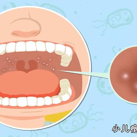 【健康课堂】疱疹性咽峡炎和手足口病的预防与区别