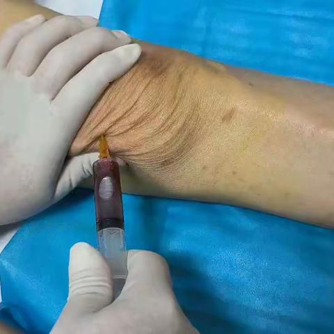 臭氧治疗骨关节疼痛