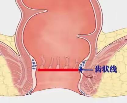 内痔 外痔 混合痔