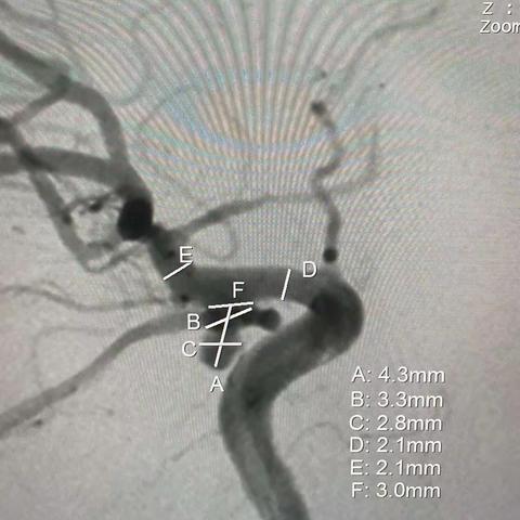 双侧后交通镜像动脉瘤分期栓塞一例