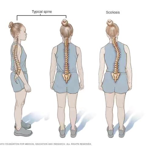 聊聊脊柱侧弯 ‍