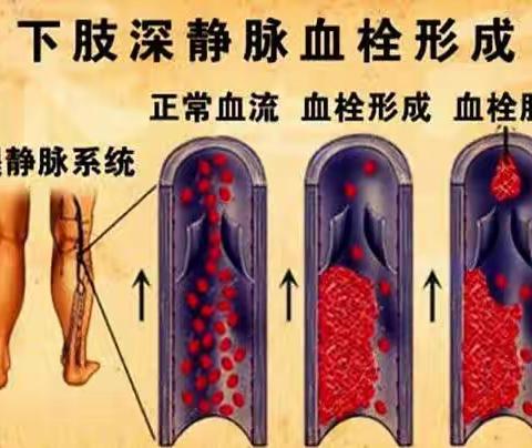 关爱生命 远离血栓 ----汤阴县人民医院开展世界血栓日科普义诊活动