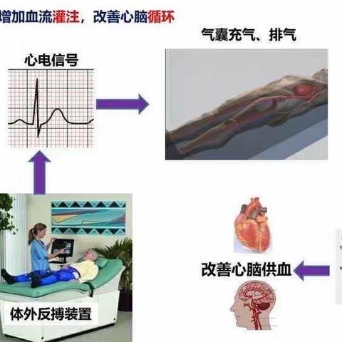 给“心脏”来一场“静态马拉松”——体外反搏疗法