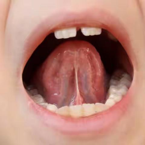 小朋友的唇系带和舌系带短，要做手术吗？