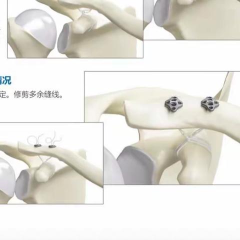 肩锁关节脱位；一次受伤两次手术，NO,我们一次就够了。