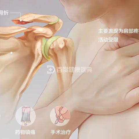 锁骨骨折