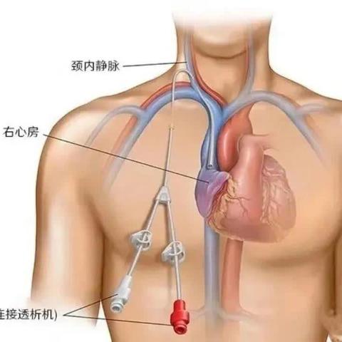 “精准植入 生命续航 ” —我院肾病内科成功开展半永久置管术