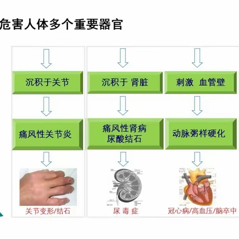 全民关注痛风日 | 告别痛风困扰，义诊活动暖心来袭～