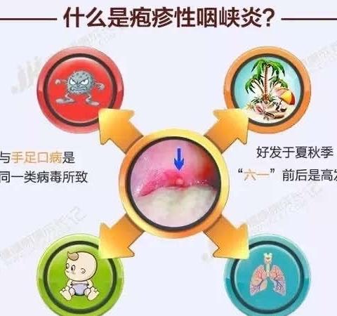 唐河县县直机关第一幼儿园卫生保健疾病预防知识——疱疹性咽峡炎