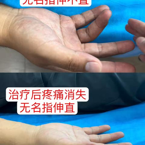 快针+皮内针治疗 狭窄性腱鞘炎一次见效