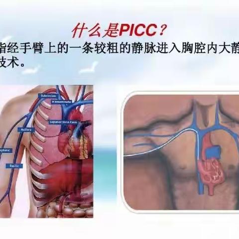 肿瘤患者的静脉输液工具选择