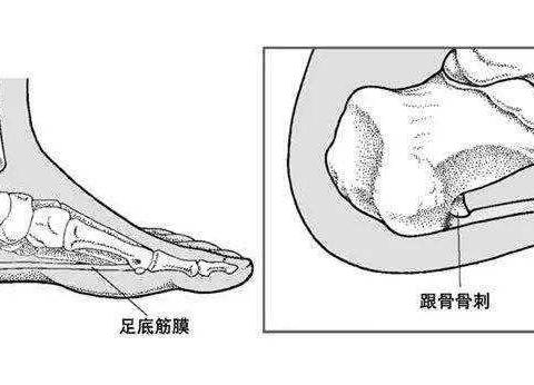 什么是足跟骨刺