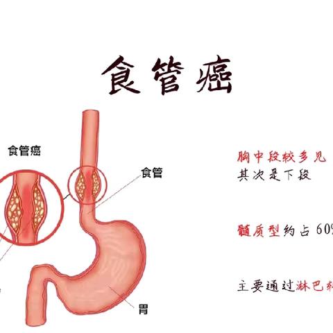 科普｜有关“吃出来的癌症”——食管癌，你了解多少?