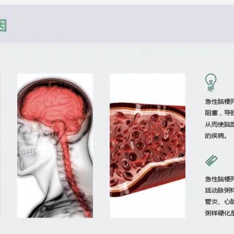 脑梗死患者支架置入健康宣教