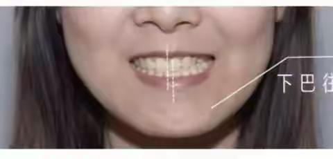 牙齿畸形，凸嘴该何去何从？——中医院四楼口腔科