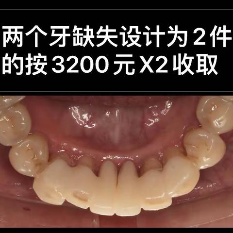 关于粘接桥的问题解答