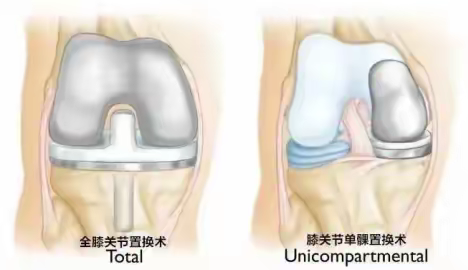 膝关节置换之单髁置换术