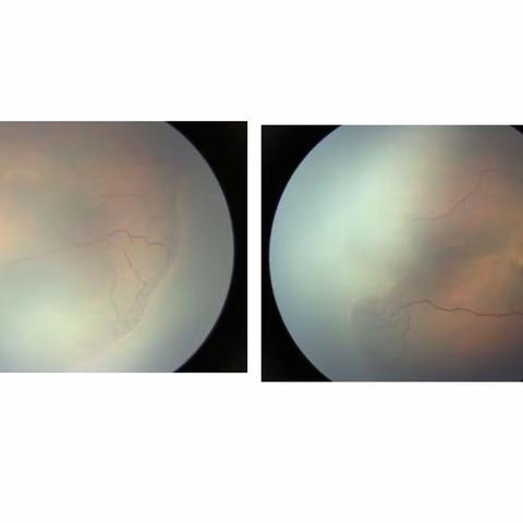 ROP患儿的福音，区域医疗中心建设再结硕果-我院成功实施首例早产儿视网膜病变玻璃体腔注药术