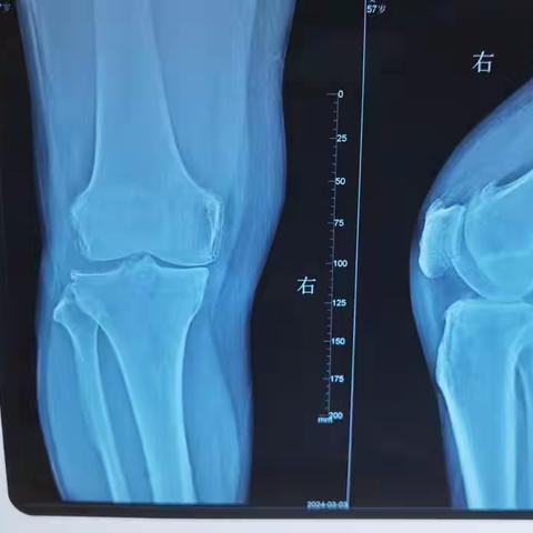 单髁置换术后的康复训练