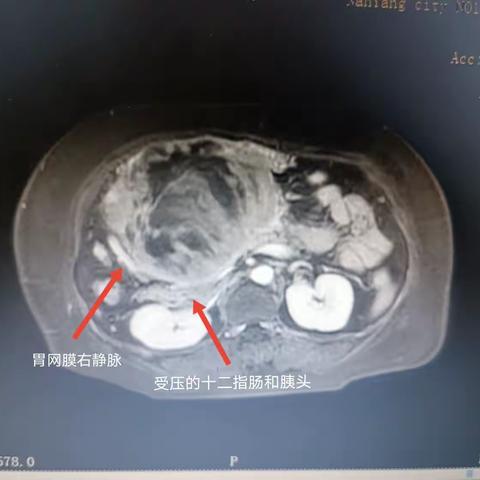 我院肝胆中心外科病区再次完成一例腹腔巨大肿瘤联合多脏器切除手术