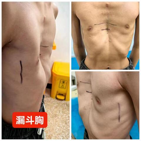 2026寒假南阳市中心医院胸壁畸形专项矫正活动正式开启