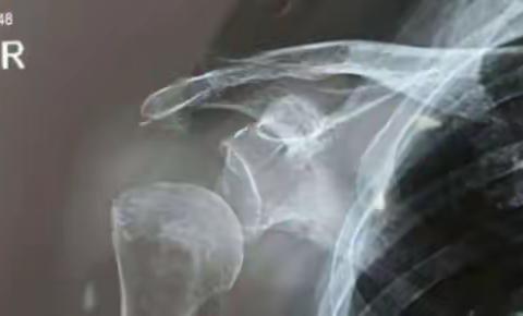 康复医学科｜脑卒中后肩关节半脱位的预防与康复治疗