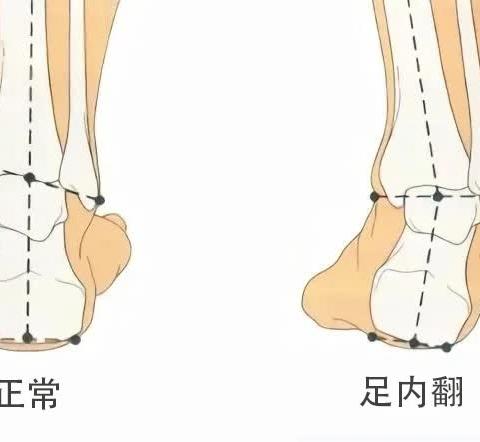 脑卒中偏瘫——足内翻康复训练