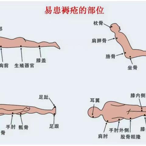 卧床患者的皮肤护理