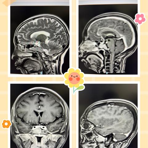 南阳市中心医院神经外科（神经肿瘤与颅底病区）-神经肿瘤篇