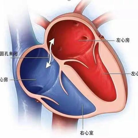 “脑”病“心”治！晋城大医院心内科开展经皮卵圆孔未闭封堵术！