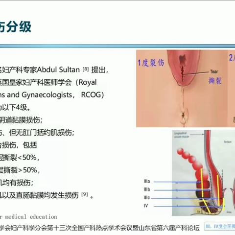 会阴裂伤的预防和缝合