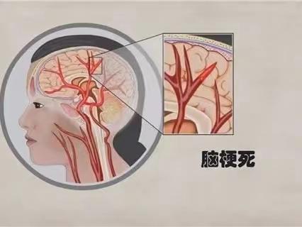 替罗非班-脑卒中患者的另一个春天