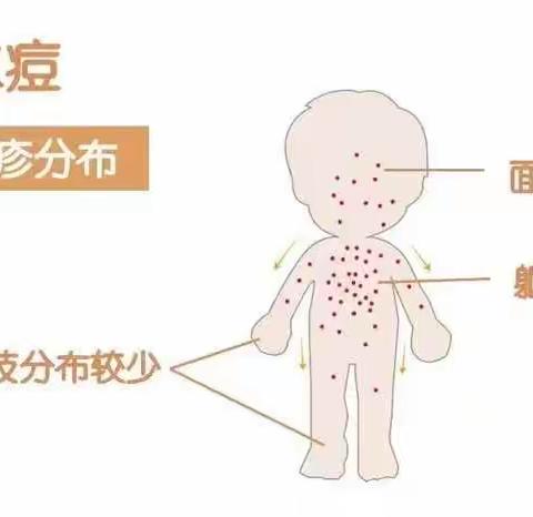 适龄儿童免费接种！蔡集镇开放水痘疫苗接种门诊