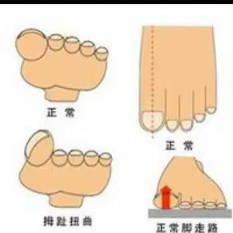 拇外翻术后保养怎么做？