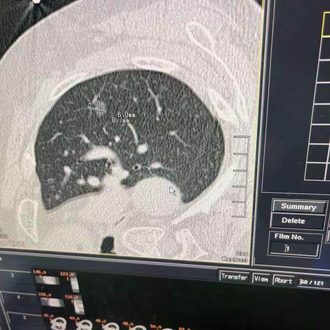 “针芯”化“结”——河南大学淮河医院胸外科CT引导下肺结节微波消融