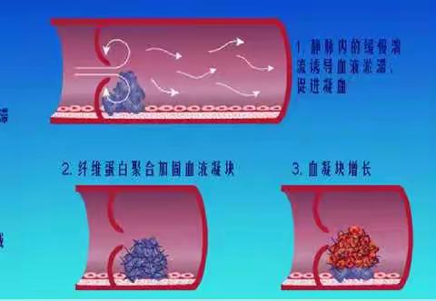 内一科深静脉血栓公休座谈会