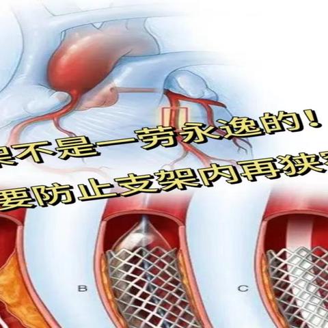 【周中医·心病科】放心脏支架≠一劳永逸！