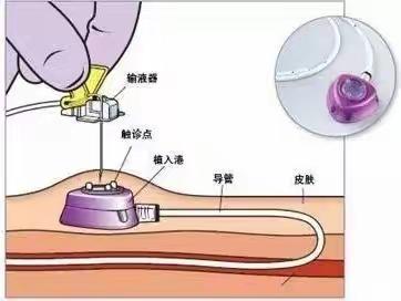 守护患者“隐形生命线”——我科成功完成“输液港植入术”