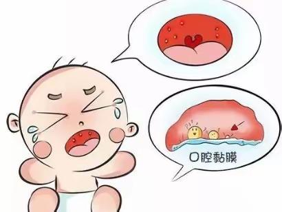 贵安新区马场中心幼儿园洋塘分园常见传染病预防——疱疹性咽峡炎