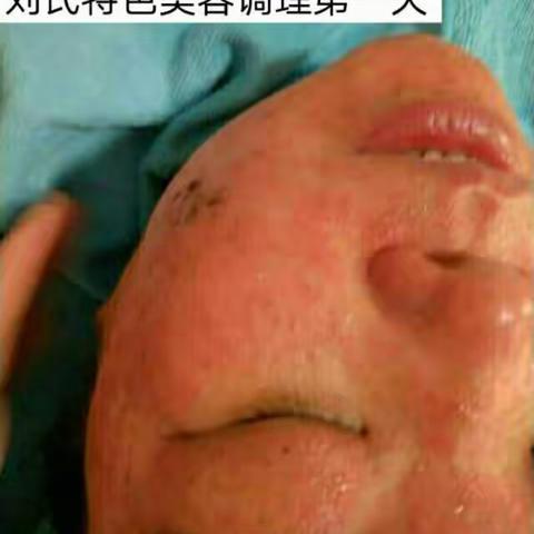 激素脸恢复健康的过程